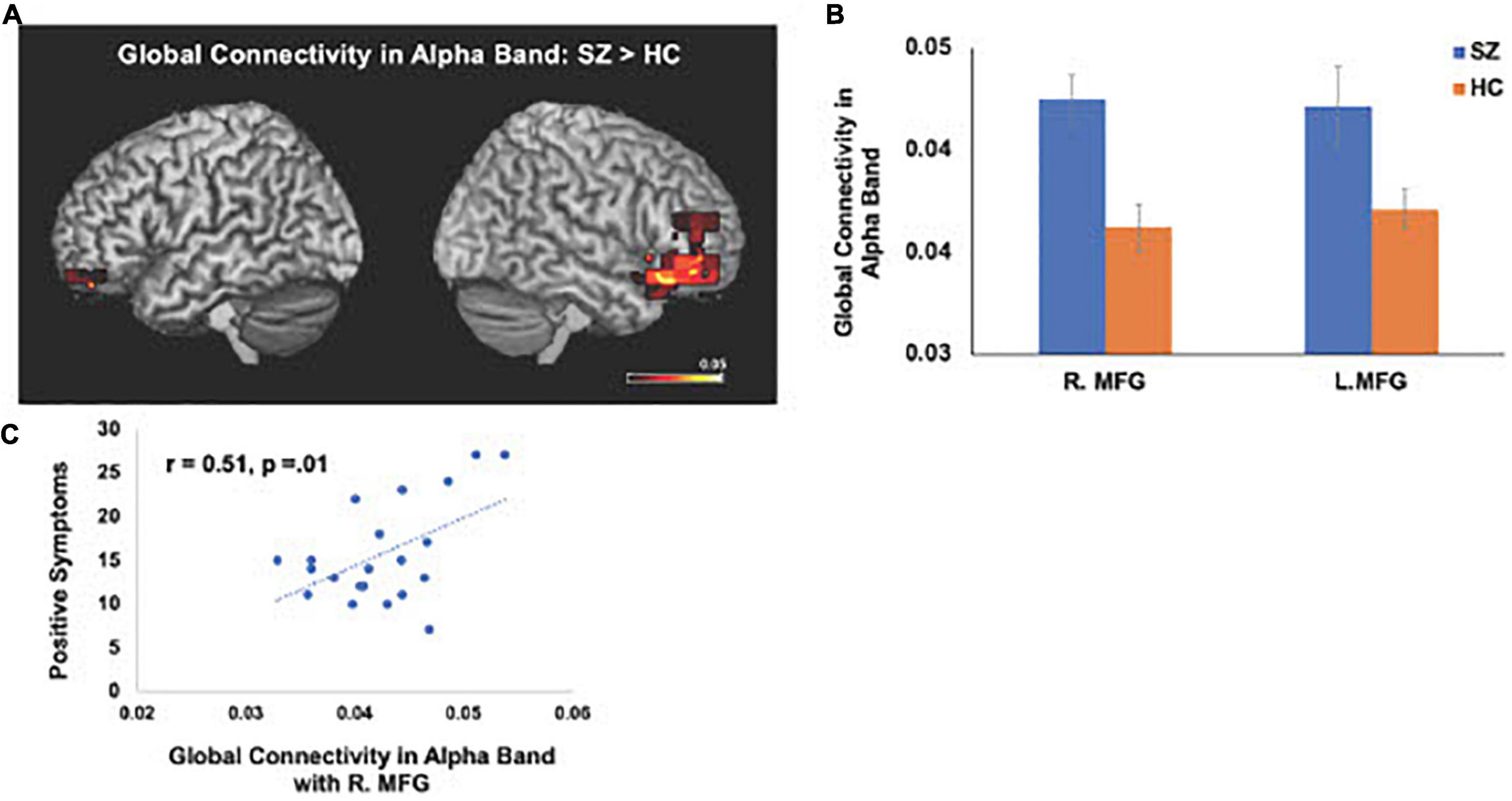 Abnormal resting-state functional connectivity underlies cognitive and clinical symptoms in patients with schizophrenia